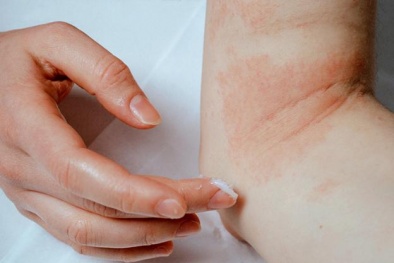 Tự ý bôi thuốc điều trị chàm da cơ địa người đàn ông bị nhiễm trùng nặng