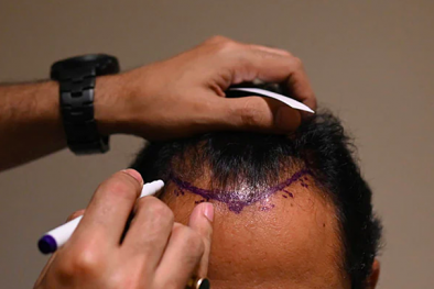 Thủ thuật cấy tóc có thể gây tử vong 