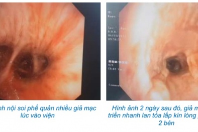 Lạm dụng uống corticoid chữa cúm khiến phổi bội nhiễm trắng xóa