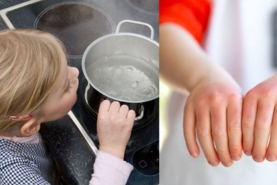Cảnh báo: 1/3 trẻ em ở Mỹ bị bỏng nước sôi do mì ăn liền