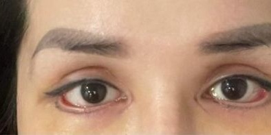 Cắt mí 'giọt lệ Trung Hoa' coi chừng gặp biến chứng nặng nề