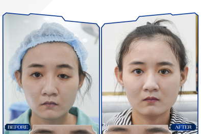 Sửa cắt mí mắt hỏng, nhược cơ tại Thẩm mỹ viện Adona