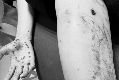 Bỏng nặng do điện thoại đang sạc phát nổ, dấu hiệu nhận biết để tránh thương tích 