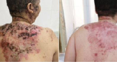 Chữa bệnh bằng tắm lá cây không rõ nguồn gốc gây bội nhiễm nguy hiểm tính mạng