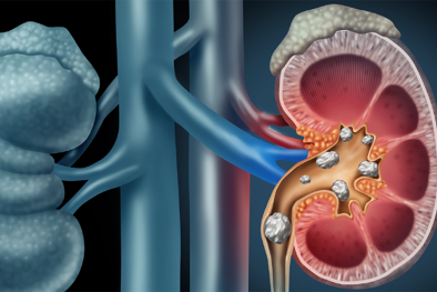 Cảnh báo: Mất một bên thận do tự ý dùng thuốc nam chữa sỏi thận