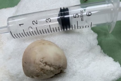 Cảnh báo: Ăn trứng vịt lộn có thể bị kẹt phần cứng trong thực quản