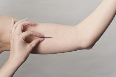 Cảnh báo: Que cấy tránh thai 'trôi' đến bắp tay 