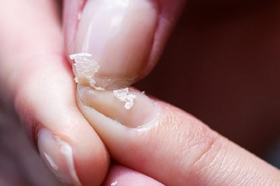 Dấu hiệu bệnh lý từ tình trạng móng tay dễ bị gãy