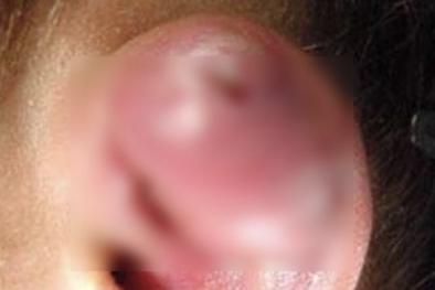 Cảnh báo: Áp xe vành tai sau khi xỏ khuyên 