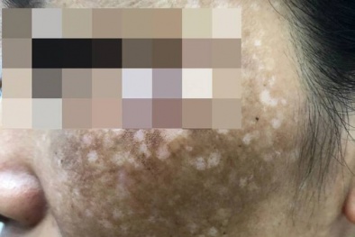 Học theo TikTok dùng lá trầu trị nám, 4 người bị viêm da kích ứng