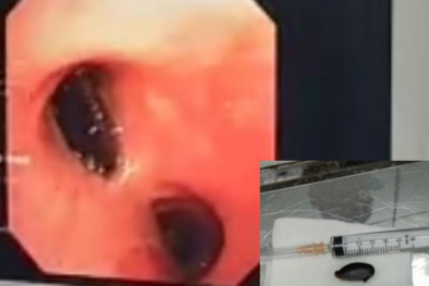 Bất cẩn trong lúc ăn uống, bệnh nhân bị mắc hạt hồng xiêm trong phế quản