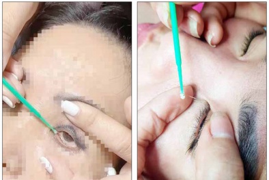 Cảnh báo: Dịch vụ 'bắt sâu trong mắt' có thể dẫn tới mù lòa