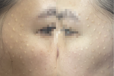 Mặt chi chít u hạt sau khi tiêm tinh chất meso white miễn phí để trẻ hóa làn da