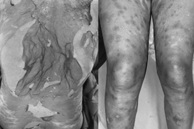 Cảnh báo: Dị ứng nặng do sử dụng thuốc nam, thuốc đông y