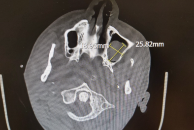 Suy thận giai đoạn 3 biến chứng sang giai đoạn 5 do tự ý dùng thuốc lạ