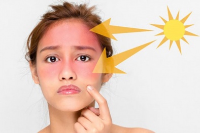 Những cách chăm sóc da bị cháy nắng hiệu quả