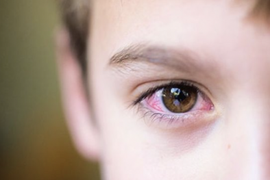 Bác sĩ chỉ cách chữa trị bệnh khô mắt ở trẻ em trong mùa hè nắng nóng