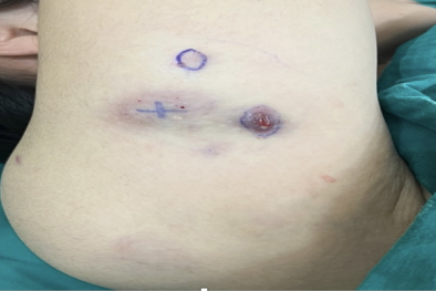 Tiêm tinh chất giảm cân có thể gây ra nhiều hiểm họa