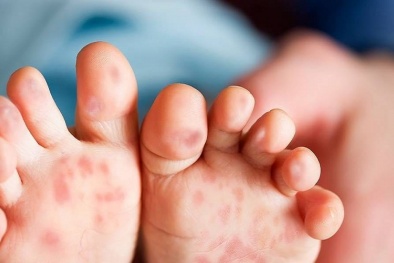 Cẩn trọng trước Virus gây bệnh tay chân miệng nặng ở trẻ em xuất hiện trở lại
