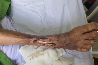 Cụ ông bị hoại tử chân do tự mua thuốc trị tiểu đường theo toa cũ