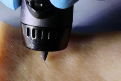 Phát triển loại bút công nghệ gel có thể chữa lành vết thương