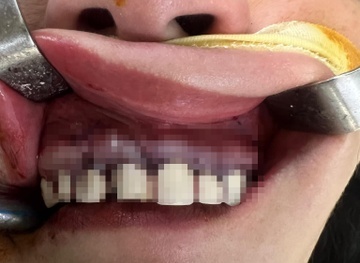 Bọc răng sứ có thể gặp biến chứng nang xương hàm nguy hiểm