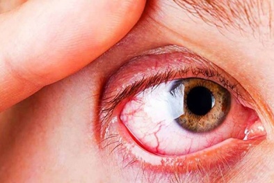 Chuyên gia cảnh báo các căn bệnh về mắt dễ mắc phải trong mùa hè và cách phòng tránh