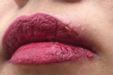 Cảnh báo: Biến chứng săm môi tại cơ sở thẩm mỹ không an toàn