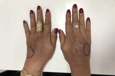 Bàn tay người phụ nữ bị biến chứng áp xe nặng do tiêm silicon tạo tay búp măng