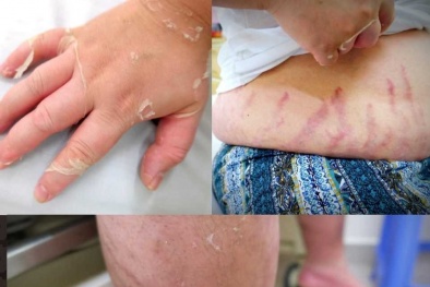 Hai anh em suy tuyến thượng thận do lạm dụng thuốc xịt mũi