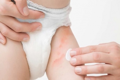Lựa chọn tã bỉm có chất lượng để tránh trẻ bị hăm, dị ứng