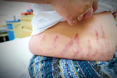 Hai anh em ruột bị suy tuyến thượng thận do sử dụng thuốc xịt mũi kéo dài