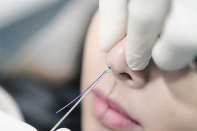 Nguy cơ biến chứng khi nâng mũi bằng chỉ sinh học collagen