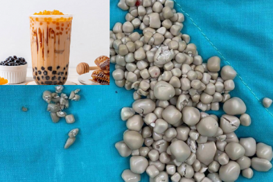 Nhập viện gắp 300 viên sỏi thận nghi do uống trà sữa thay nước lọc