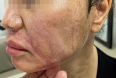 Bỏng nặng vùng mặt do peel da trị nám sai cách tại một spa 