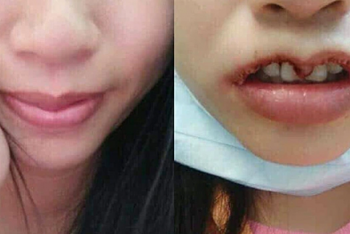 Cảnh báo: Đa số bệnh nhân biến chứng cầu cứu bác sĩ đều làm đẹp ở spa, tiệm cắt tóc