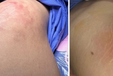 Gánh hậu quả nghiêm trọng sau khi tiêm filler cải thiện vòng 3