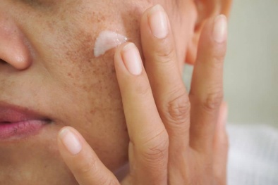 Da mặt biến chứng sau liệu trình dùng kem trị nám cấp tốc mua trên mạng