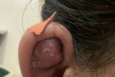 Biến chứng nguy hiểm do xỏ khuyên ở vành tai không đảm bảo