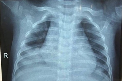 Suýt mất mạng do trẻ uống nhầm dầu hỏa