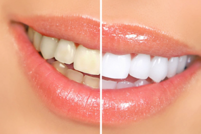 Chưa có bằng chứng khoa học chứng minh dùng oxy già tẩy trắng răng hiệu quả