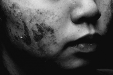 Thiếu nữ bong tróc da mặt sau khi tự trị mụn tại nhà