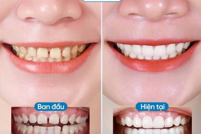 Răng toàn sứ - Đỉnh cao công nghệ thẩm mỹ, phục hình răng