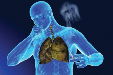 Mỹ cấp phép thuốc có thể 'điều khiển' hệ miễn dịch cơ thể để tiêu diệt tế bào ung thư phổi