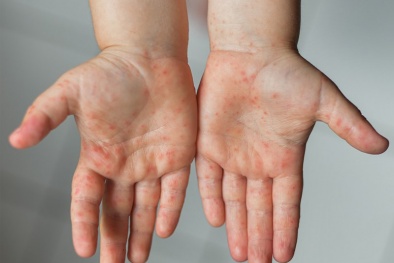 Người dân lưu ý phòng ngừa bệnh tay chân miệng đang có chiều hướng gia tăng tại phía Nam