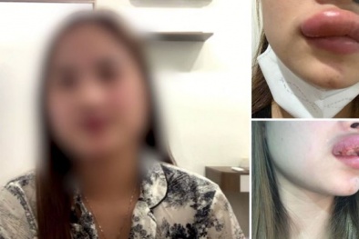 Dịch vụ tuyển mẫu tiêm filler giá rẻ tại các cơ sở thẩm mỹ liệu có an toàn?