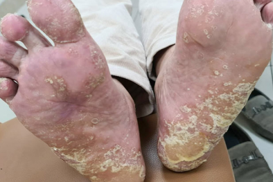 Nhiễm trùng do dùng hóa chất tẩy rửa tại nhà