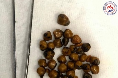 Người phụ nữ có túi mật chứa 40 viên sỏi