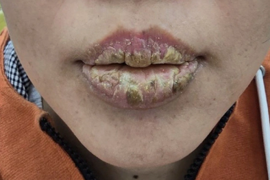 Môi sưng phồng, đóng vẩy dày vì xăm môi tại một thẩm mỹ viện