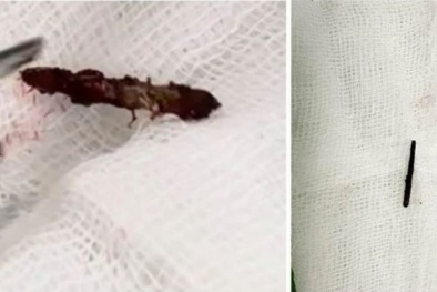 Khám sức khỏe định kỳ, phát hiện đinh rỉ trong cổ họng